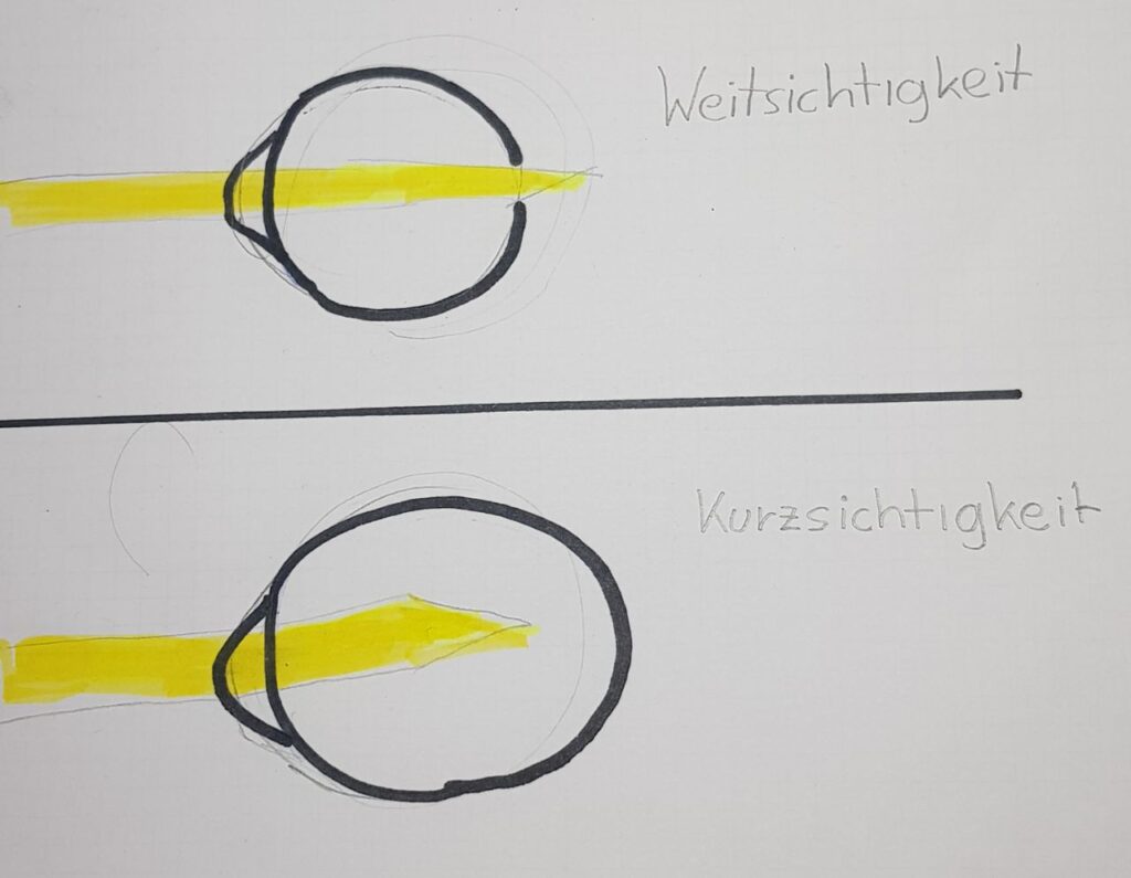 Weitsichtigkeit und Kurzsichtigkeit schematisch dargestellt